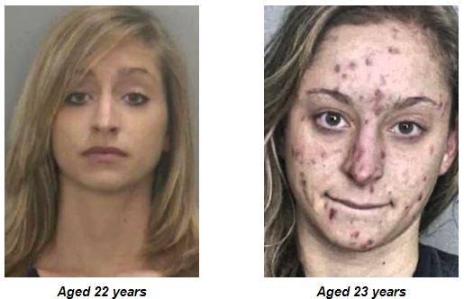 5 Real Heroin Before And After Pictures - Effect On The Body - Modern ...