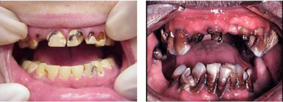 Meth mouth pictures1