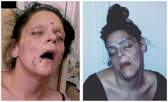 Melissa Heroin before and after pictures